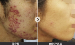 <b>夏天“祛痘”的正确打开方式在这里，痘痘的形</b>